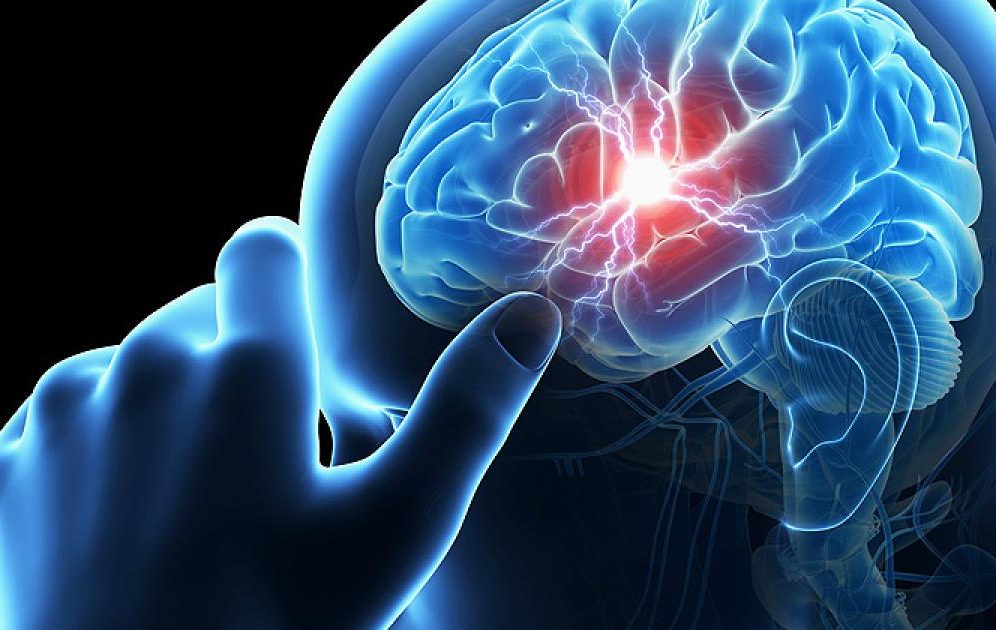 Stroke Prevention