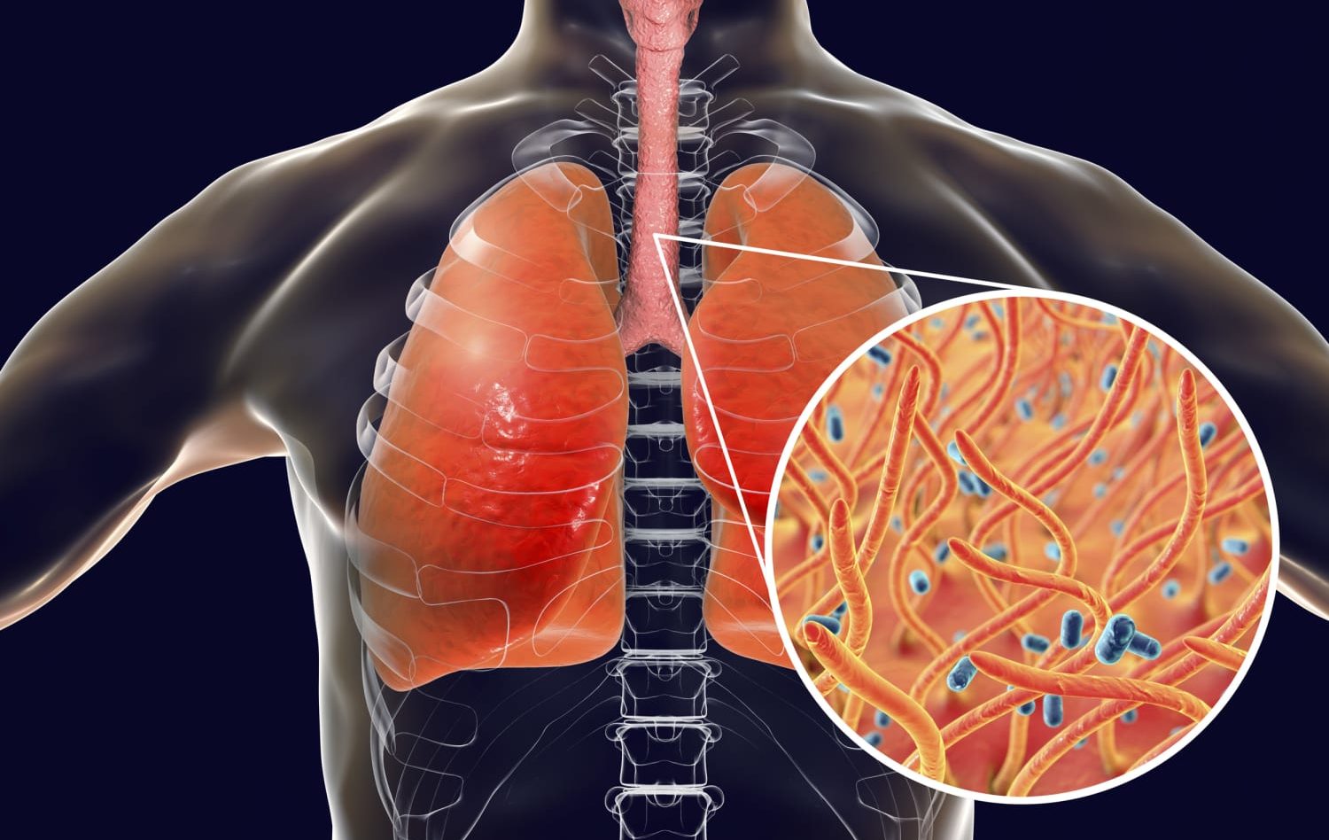 Whooping Cough Persistent Yet Preventable