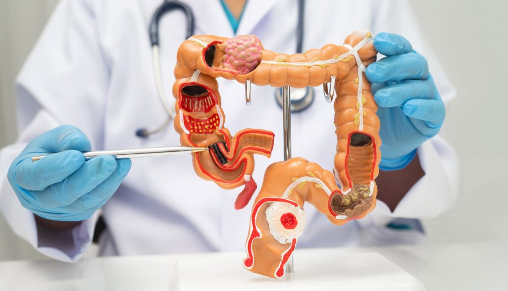 colon-cancer