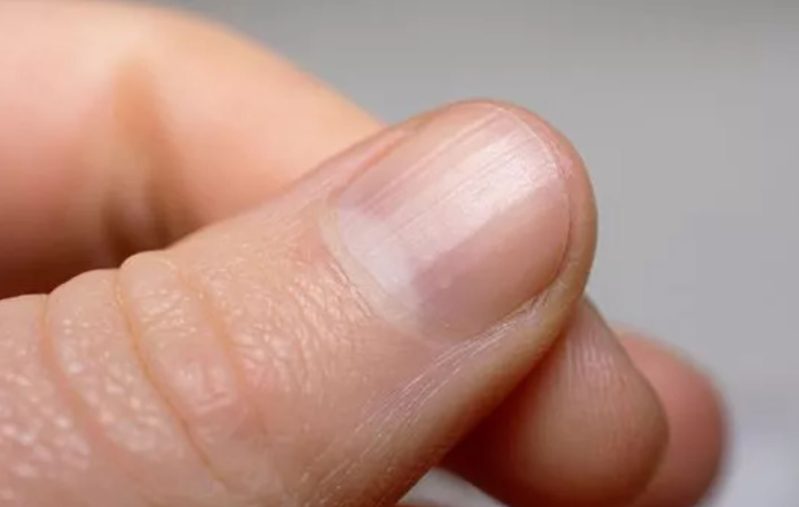 What You Need to Know About Nail Cancer